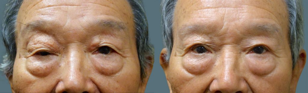 Bilateral Upper Eyelid Blepharoplasty, Right Upper Eyelid External Ptosis Repair - Revision Of Prior Surgery Patient 05-A 
