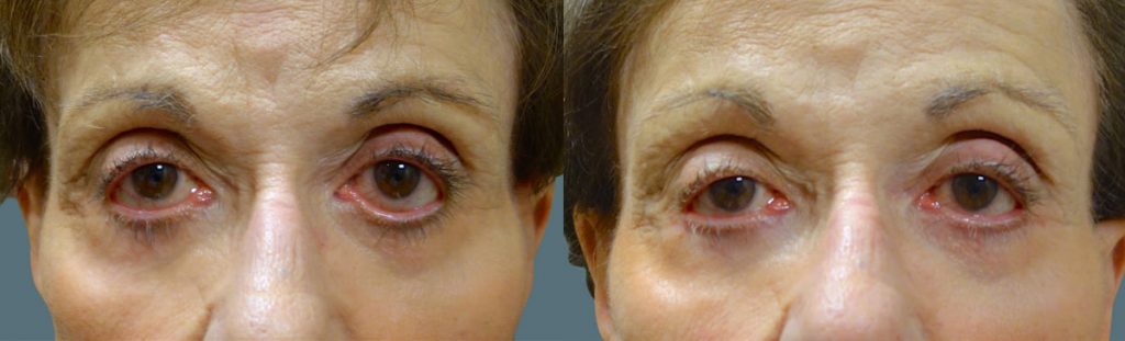 Eyelid Hollowing and Retraction After Lower Eyelid Blepharoplasty - Repaired with Minimally Invasive Revision Surgery Patient 04-A 