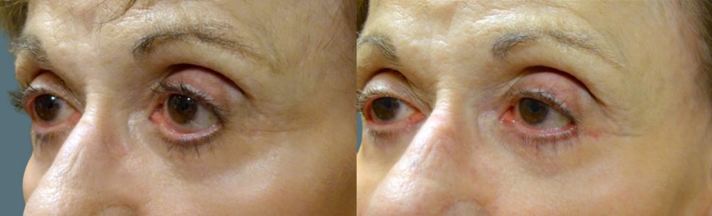 Eyelid Hollowing and Retraction After Lower Eyelid Blepharoplasty - Repaired with Minimally Invasive Revision Surgery Patient 04-B 