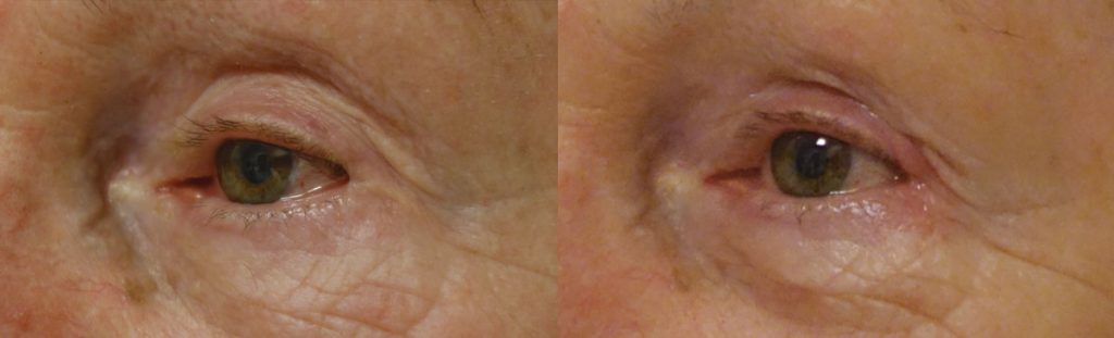 Left Lateral Canthal Web After Lower Eyelid Blepharoplasty - Repair with Micro Flap Revision Surgery Patient 03 