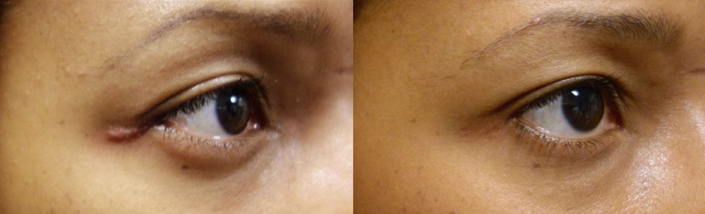 Right Lateral Canthal Keloid Scar After Eyelid Surgery - Repaired with In Office Non Surgical Revision Patient 02 