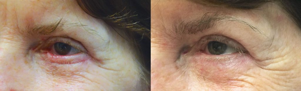 Scarring and Ectropion After Lower Eyelid Blepharoplasty - Non Surgical In Office Revision Patient 01 