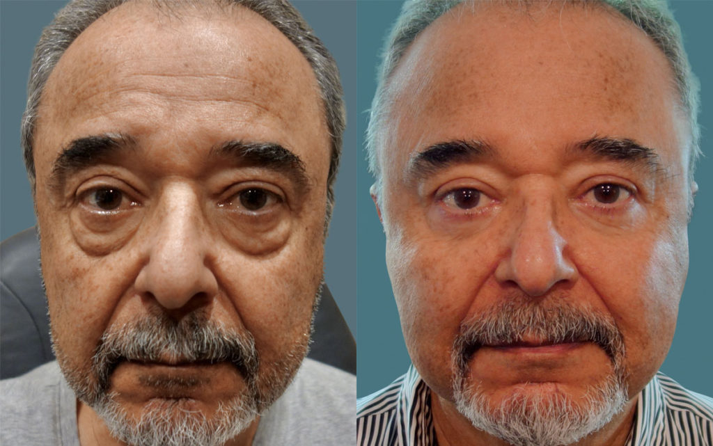 Bilateral Upper and Lower Eyelid Blepharoplasty Patient 49-A 