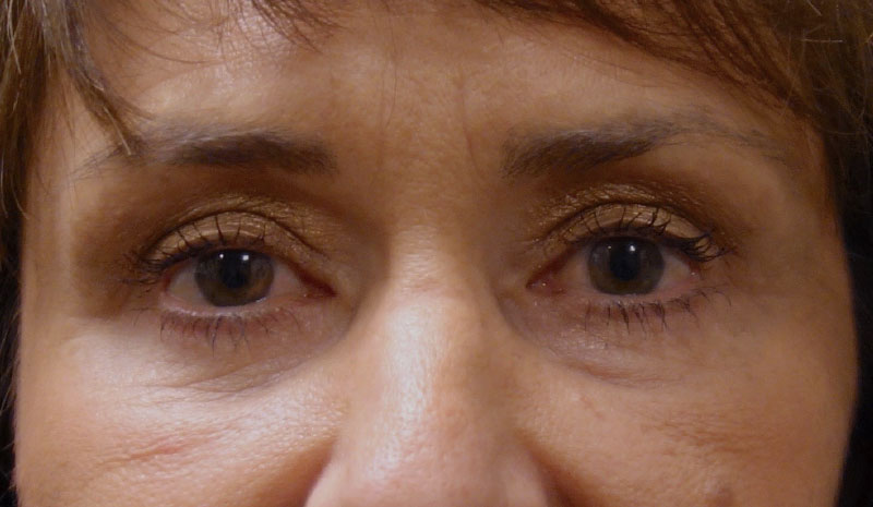 After Eyelid Treatment Patient Front Angle