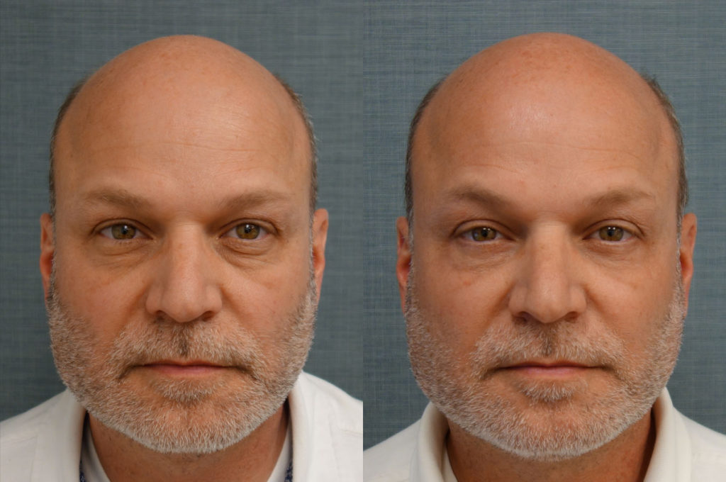 Bilateral Lower Eyelid Blepharoplasty, Chemical Peel to Lower Eyelids Patient 42-A 
