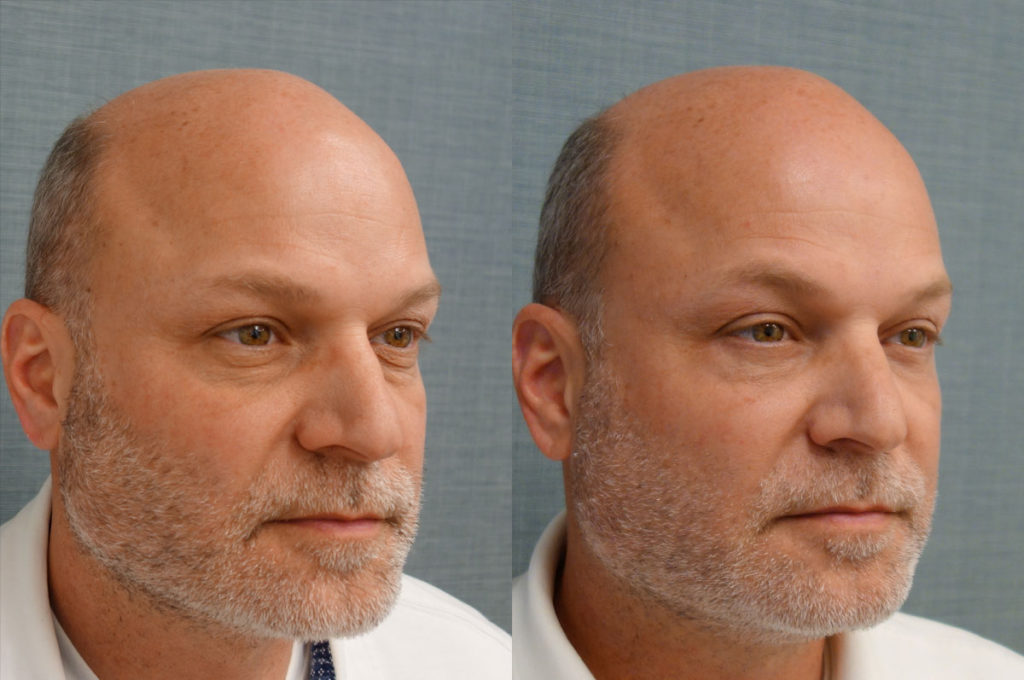 Bilateral Lower Eyelid Blepharoplasty, Chemical Peel to Lower Eyelids Patient 42-B 