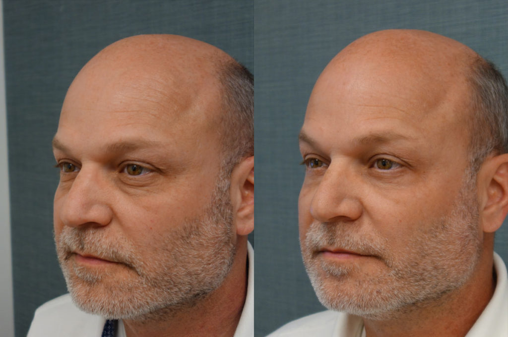 Bilateral Lower Eyelid Blepharoplasty, Chemical Peel to Lower Eyelids Patient 42-C 