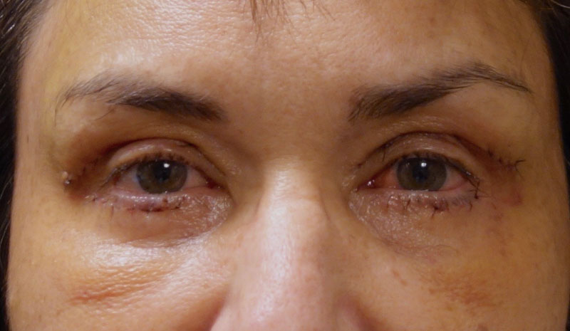 Before Eyelid Treatment Patient Front Angle
