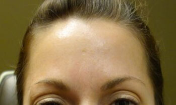 After Botox Treatment Patient 1 Front Angle After Botox Treatment Patient 1 Front Angle