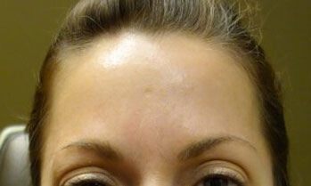 After Botox Treatment Patient 1 Front Angle