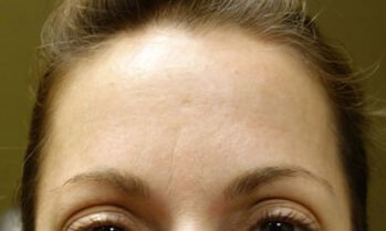 Before Botox Treatment Patient 1 Front Angle