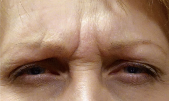 Before Botox Treatment Patient 11 Front Angle