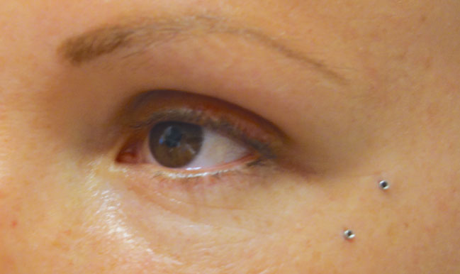 After Chalazion Treatment Patient 18 Side Angle