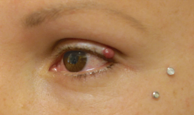 Before Chalazion Treatment Patient 18 Side Angle