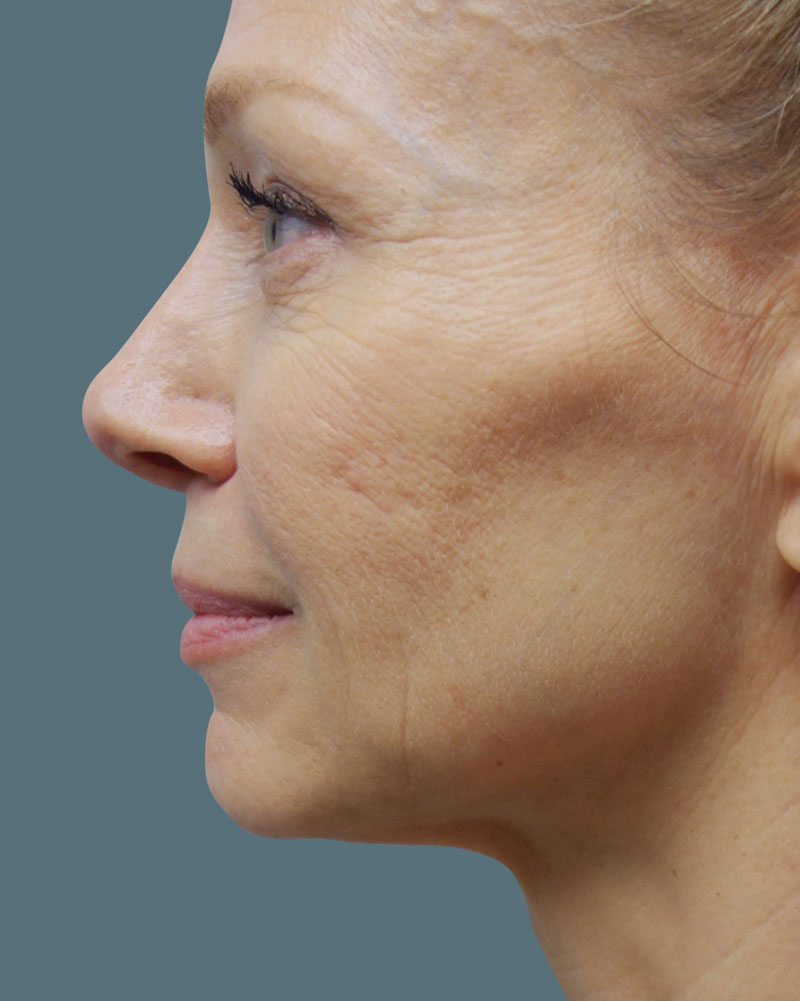 After Facetite and Accutite Treatment Patient 19 Side Angle