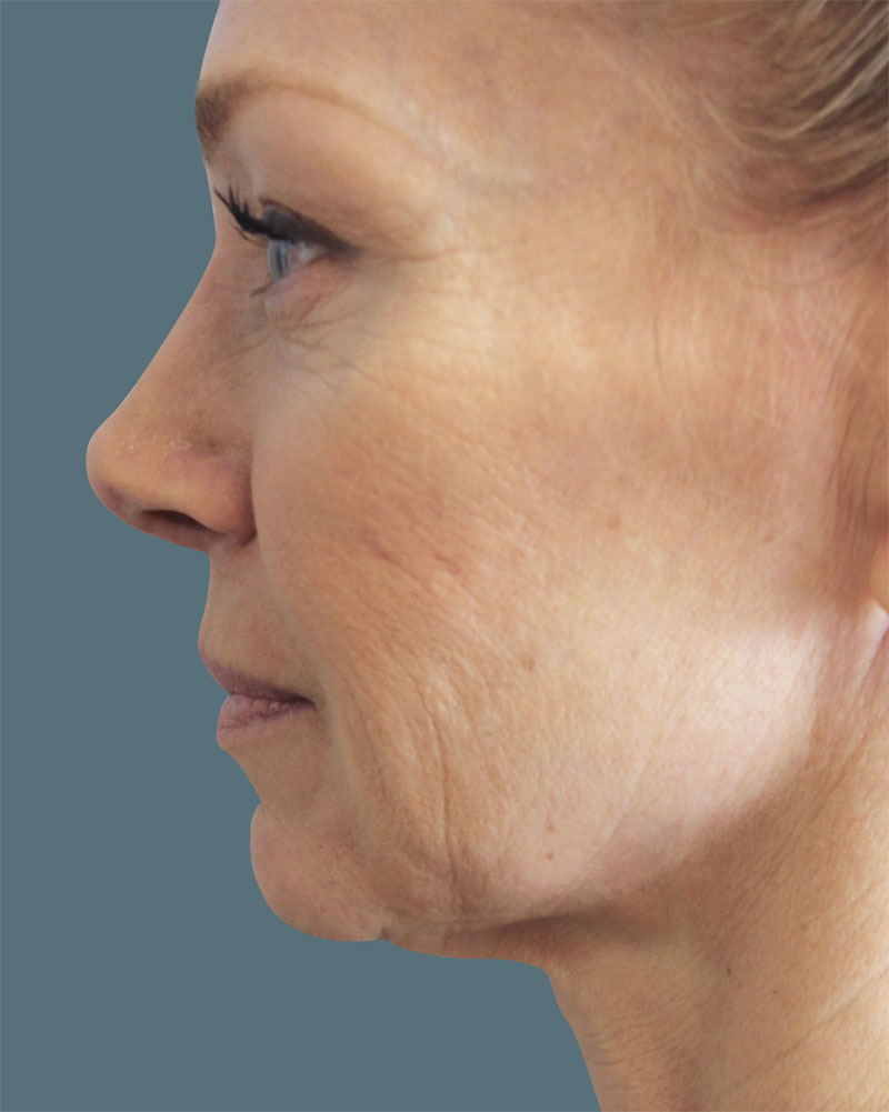 Before Facetite and Accutite Treatment Patient 19 Side Angle