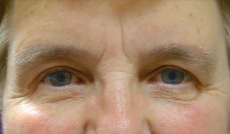 After Upper Eyelid Blepharoplasty Treatment Patient 2 Front Angle