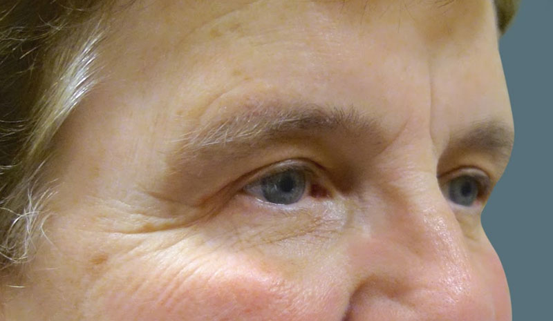 After Upper Eyelid Blepharoplasty Treatment Patient 2 Side Angle