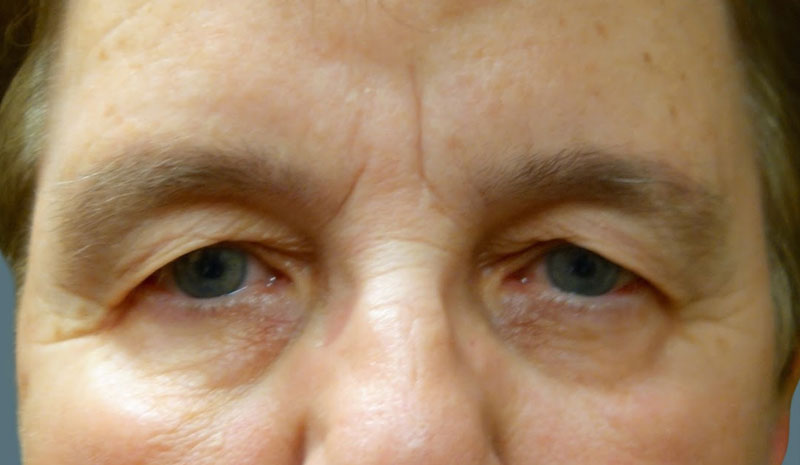 Before Upper Eyelid Blepharoplasty Treatment Patient 2 Front Angle