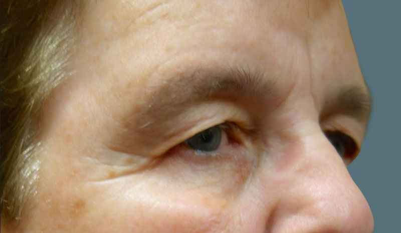 Before Upper Eyelid Blepharoplasty Treatment Patient 2 Side Angle