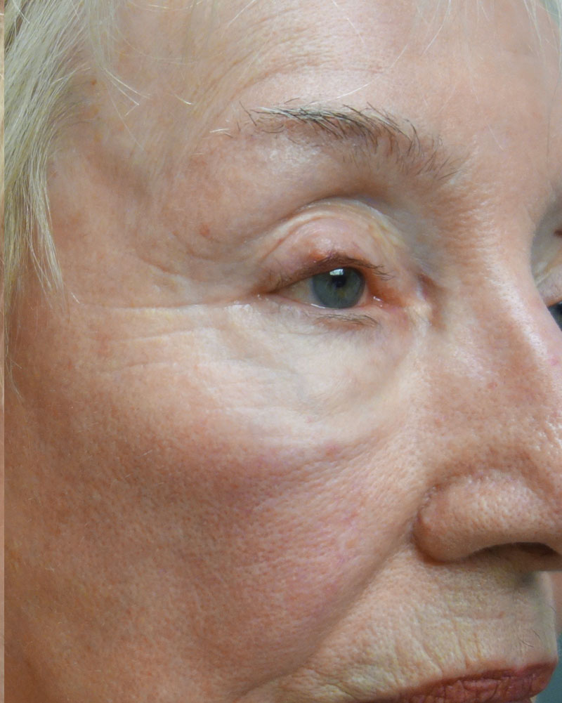 After Morpheus8 Microneedling Treatment Patient 20 Side Angle