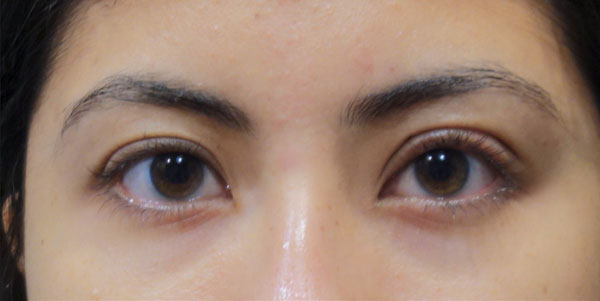 After Ptosis Repair Front Angle