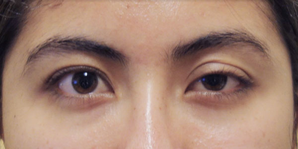 Before Ptosis Repair Front Angle