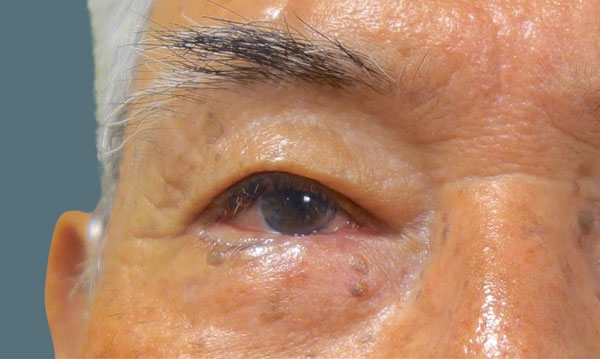After Eyelid Cancer Front Angle