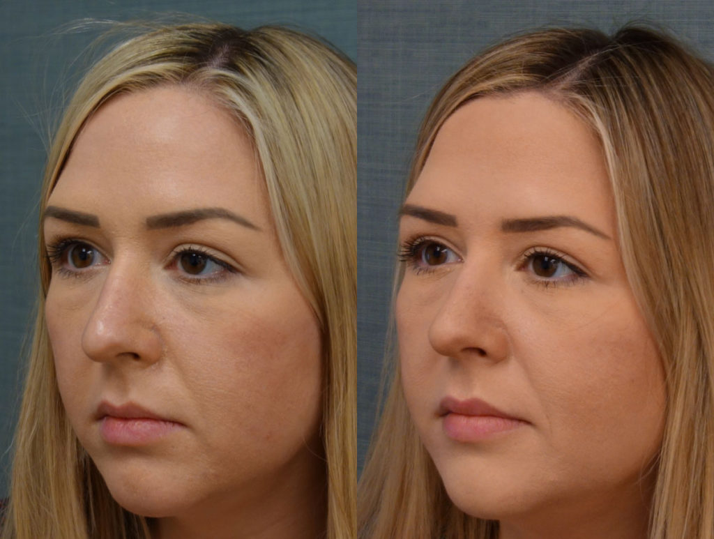 Upper Eyelid Blepharoplasty, Left Upper Eyelid External Ptosis Repair Patient 20-C 