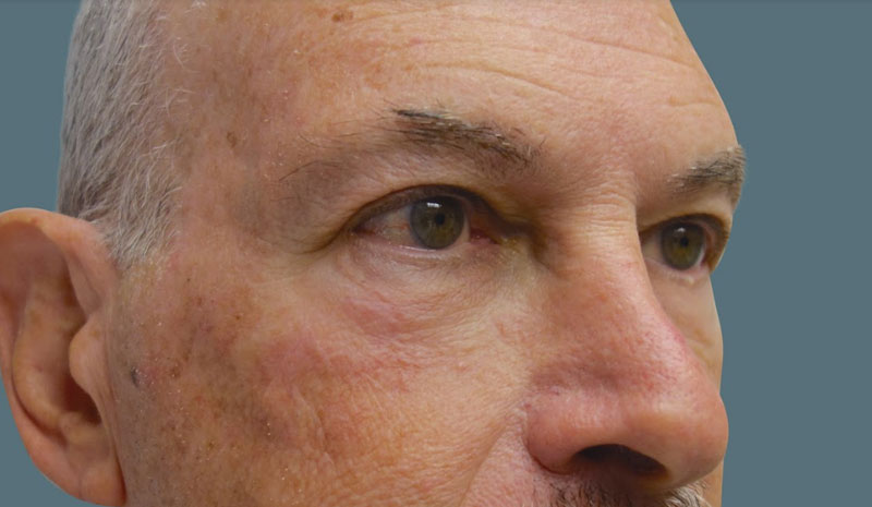 After Lower Eyelid Blepharoplasty Treatment Patient 3 Side Angle