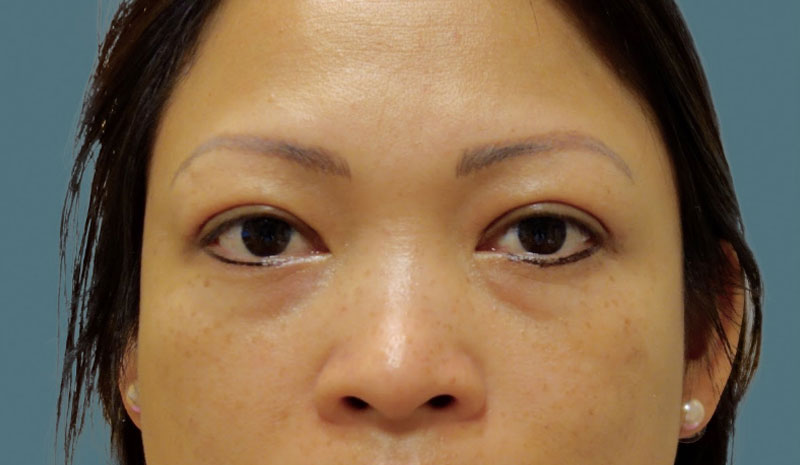 After Eyelid Crease Surgery Asian Blepharoplasty Treatment Patient 8 Front Angle