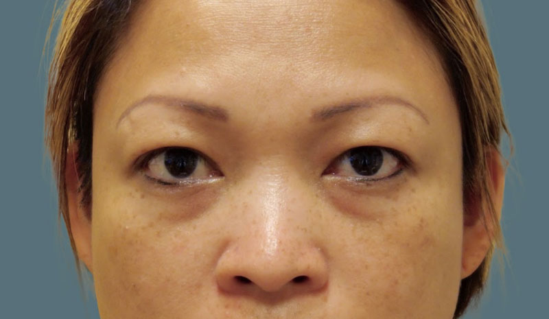 Before Eyelid Crease Surgery Asian Blepharoplasty Treatment Patient 8 Front Angle