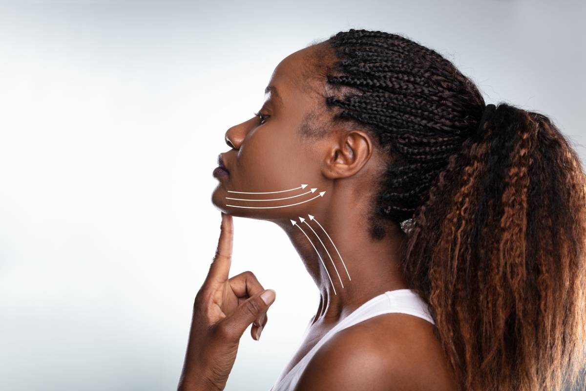 Woman with lines on face representing cheek lift