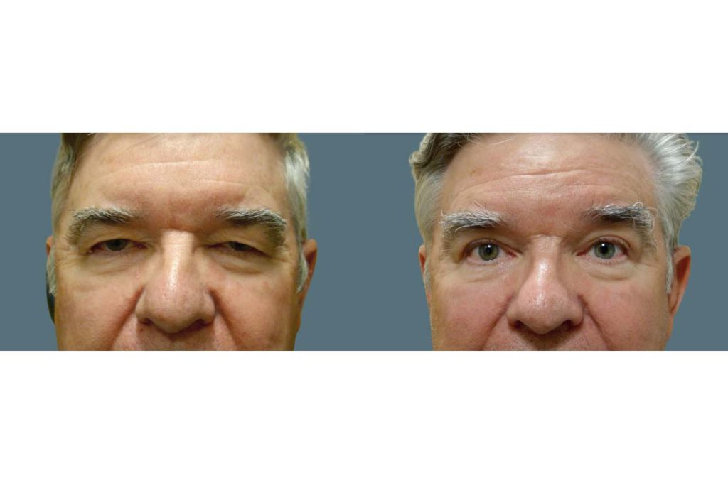 Upper Eyelid Blepharoplasty and Internal Ptosis Repair Patient 10-B 