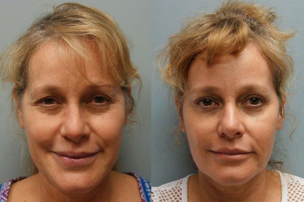 Upper Eyelid Blepharoplasty, Mini Brow Lift and Laser Resurfacing Patient 38-A 