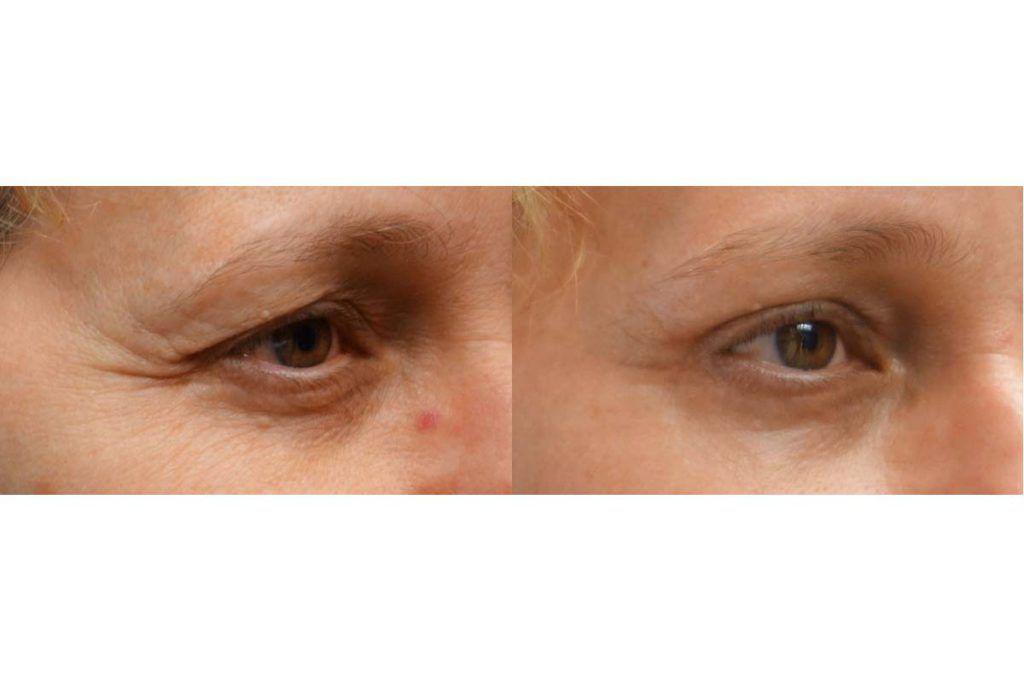 Upper Eyelid Blepharoplasty, Mini Brow Lift and Laser Resurfacing Patient 38-B 