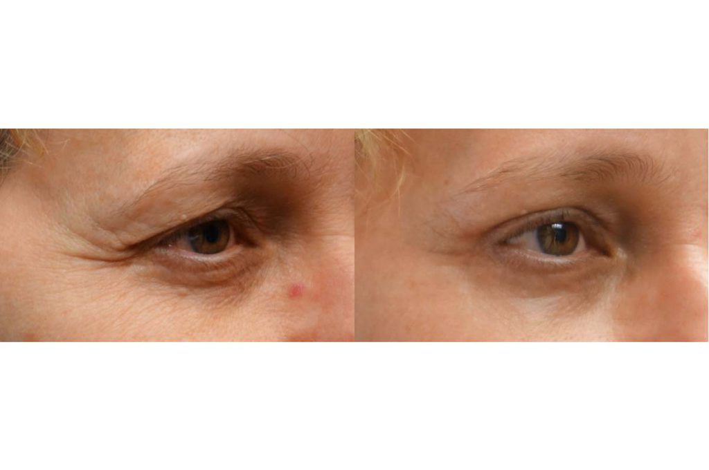 Upper Eyelid Blepharoplasty, Mini Brow Lift and Laser Resurfacing Patient 39-B 