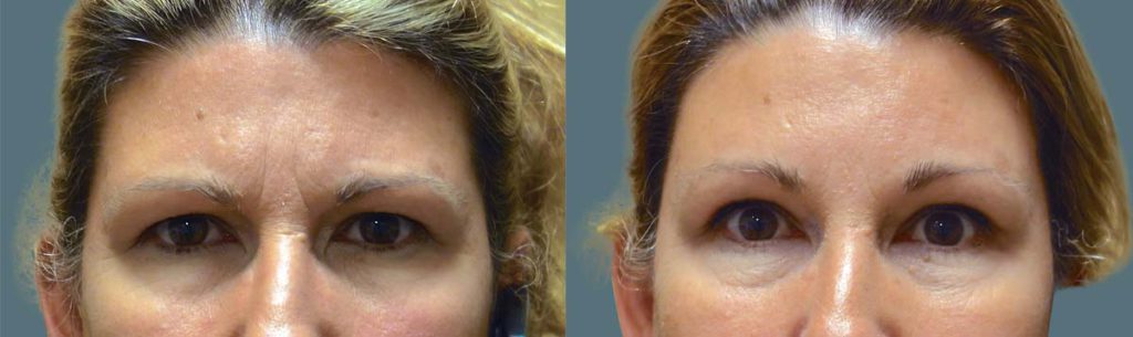 Upper Eyelid Blepharoplasty and Endoscopic Brow Lift Patient 48-A 