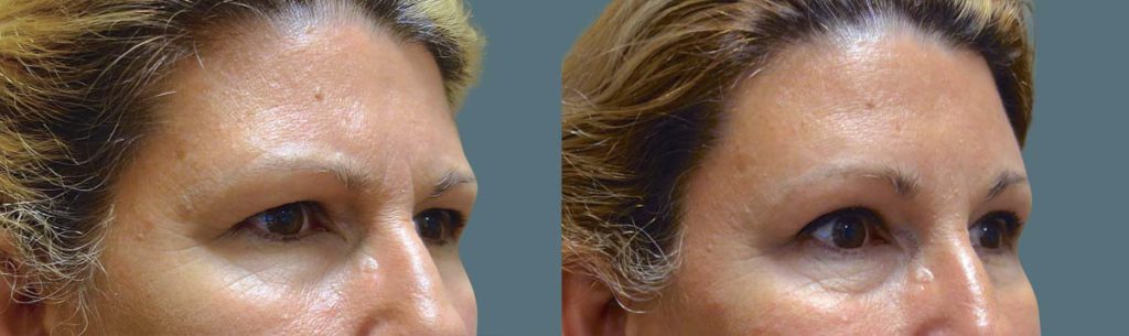 Upper Eyelid Blepharoplasty and Endoscopic Brow Lift Patient 47-B 