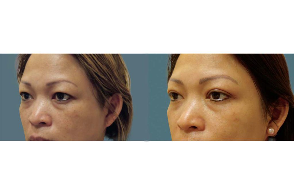 Asian Upper Eyelid Blepharoplasty Patient 10-B 