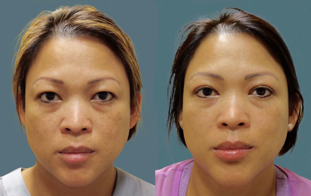 Asian Upper Eyelid Blepharoplasty Patient 10-A 