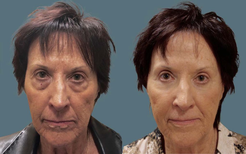 Upper and Lower Eyelid Blepharoplasty, Mini Brow Lift and Laser Resurfacing Patient 44-A 