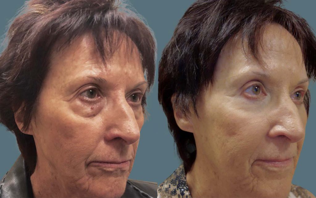 Upper and Lower Eyelid Blepharoplasty, Mini Brow Lift and Laser Resurfacing Patient 45-B 