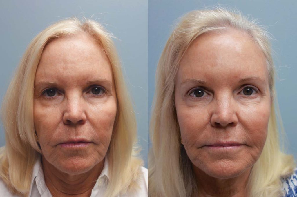 Upper Eyelid Blepharoplasty and Mini Brow Lift, Patient 41-A 