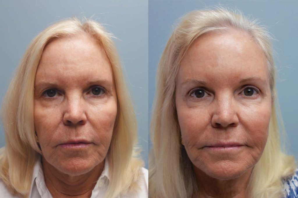 Upper Eyelid Blepharoplasty and Mini Brow Lift, Patient 42-A 
