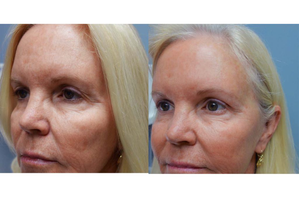 Upper Eyelid Blepharoplasty and Mini Brow Lift, Patient 42-B 