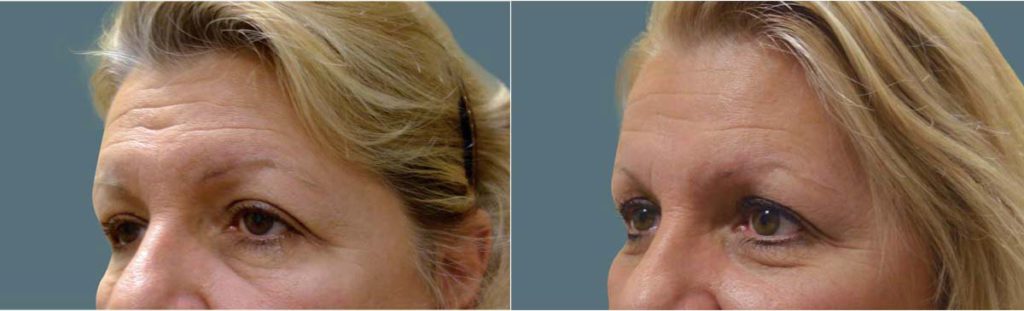 Upper Eyelid Blepharoplasty, Bilateral Internal Eyelid Ptosis Repair and Endoscopic Brow Lift Patient 28-B 