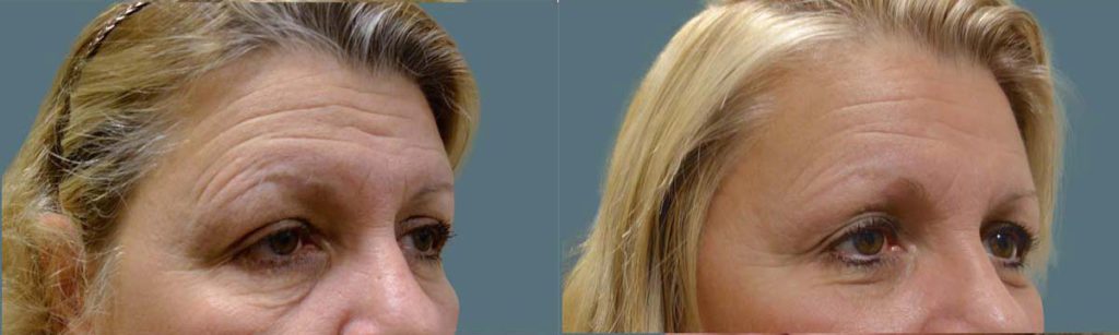 Upper Eyelid Blepharoplasty, Bilateral Internal Eyelid Ptosis Repair and Endoscopic Brow Lift Patient 28-C 