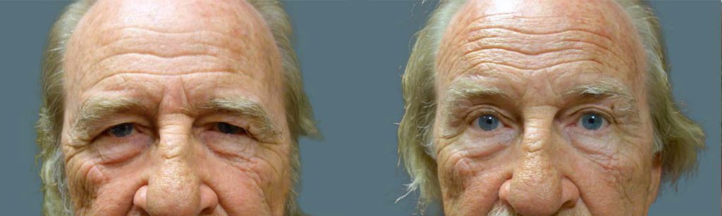 Upper Eyelid Blepharoplasty and Endoscopic Brow Lift Patient 25-A 