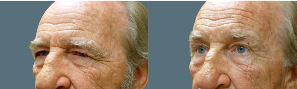 Upper Eyelid Blepharoplasty and Endoscopic Brow Lift Patient 25-B 